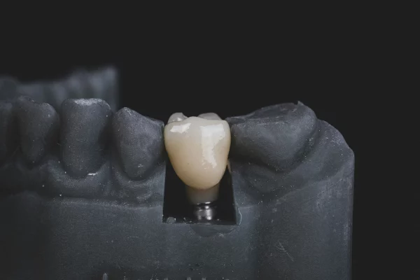 Illustration of dental implants with a focus on titanium post and crown placement.